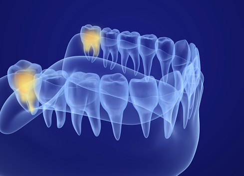 3D xray of wisdom teeth at Downey Oral and Maxillofacial Surgery in Downey, CA