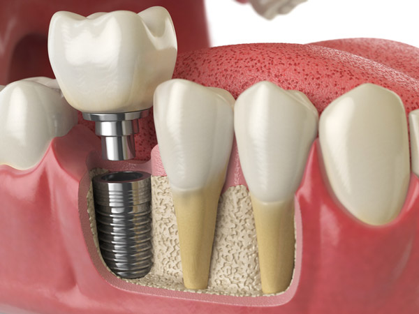 Diagram of dental implant in to jaw bone at Downey Oral and Maxillofacial Surgery in Downey, CA